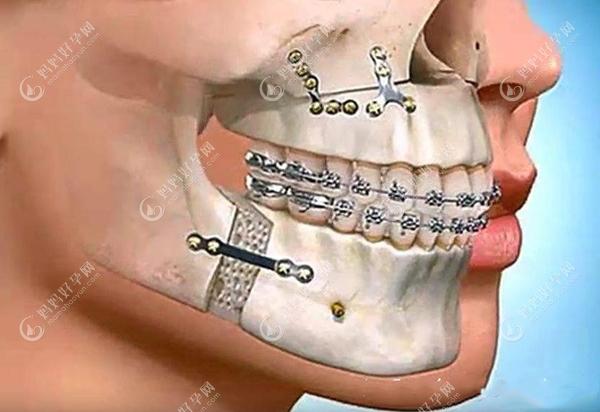 成人骨性龅牙做正颌手术得多久恢复,是否会留下什么后遗症