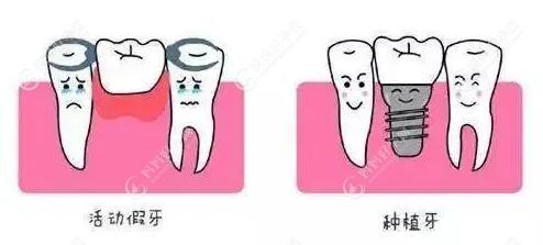 活动假牙和种植牙对比图