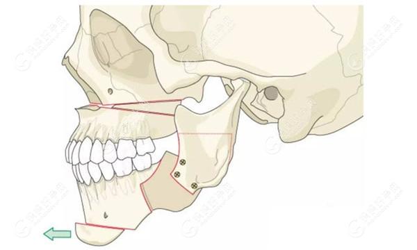 下颌后缩是做正颌还是颏成型手术