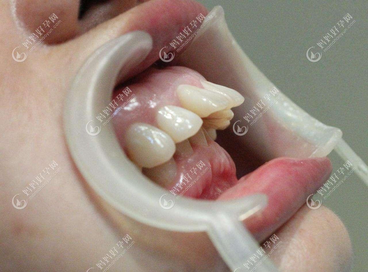 腺样体肥大牙齿图图片