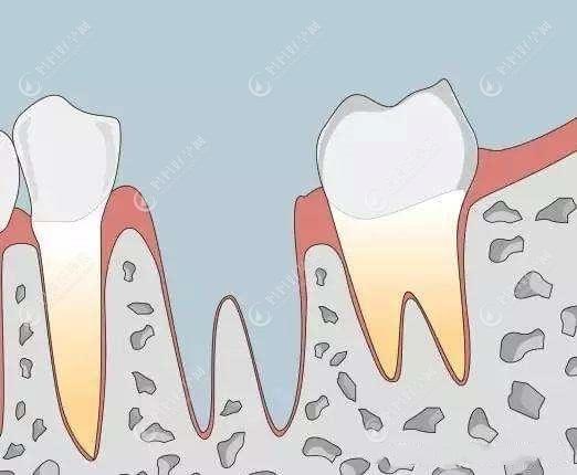 缺一颗牙是做活动义齿好还是固定义齿好?医生说做种植牙好!