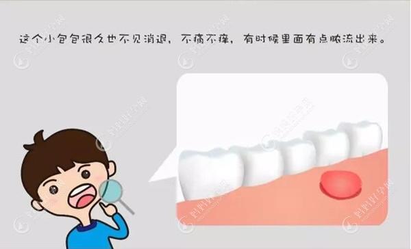 儿童牙根尖炎的症状表现