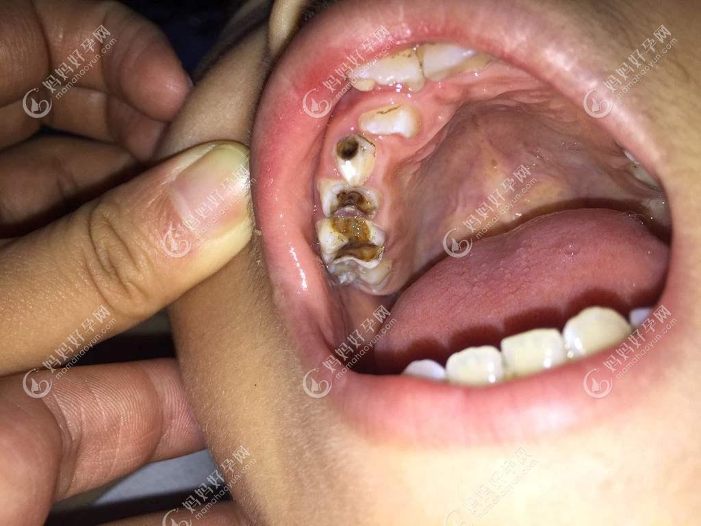 牙根存留在口腔mama,会对口腔造成持续的造成一些刺激,导致孩子口气不