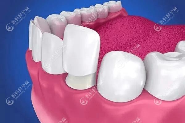 牙齿贴面的危害和后遗症
