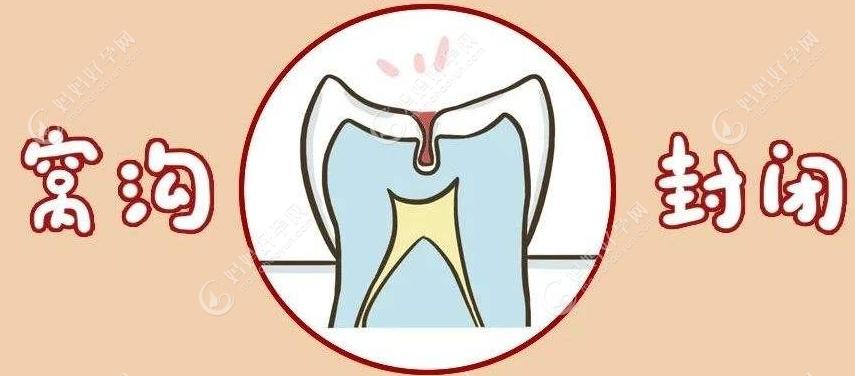 牙医建议一般3-6个月进行一次涂氟