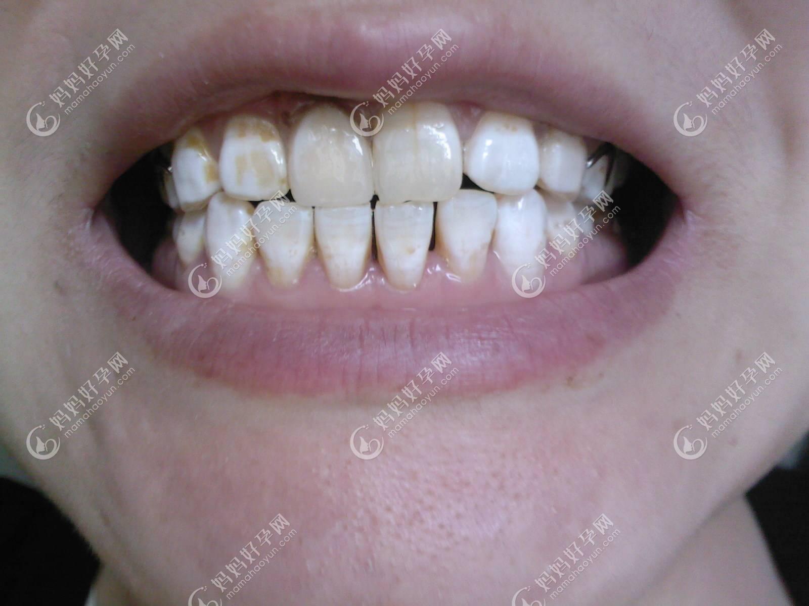 氟斑牙常见于乳牙还是恒牙?想知道怎么判断是不是氟斑牙