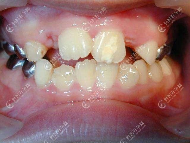 婴幼儿牙齿钙化会自愈恢复吗