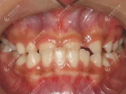 乳牙地包天换牙会好吗小孩乳牙地包天什么时候矫正最好