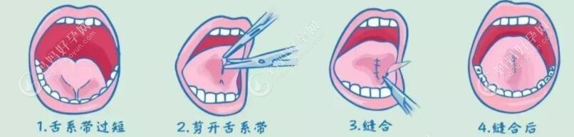 舌系带短手术过程