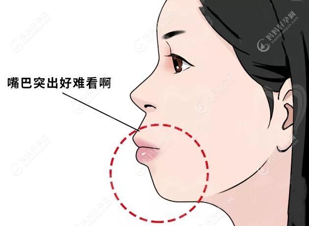 骨性嘴凸是深覆盖还是深覆合,矫正后嘴型和脸型变化大吗