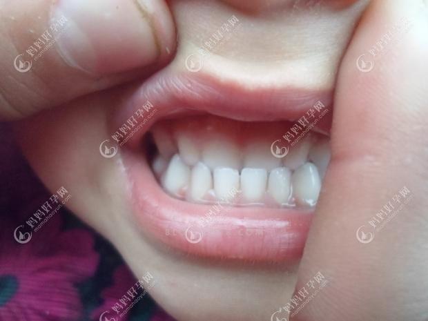 牙齿天包地正常吗图片