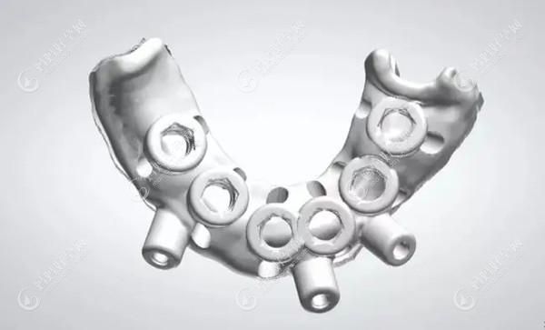 3D数字化导板种植牙的优势及流程