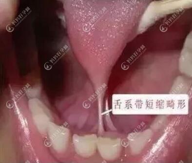 舌系带短畸形