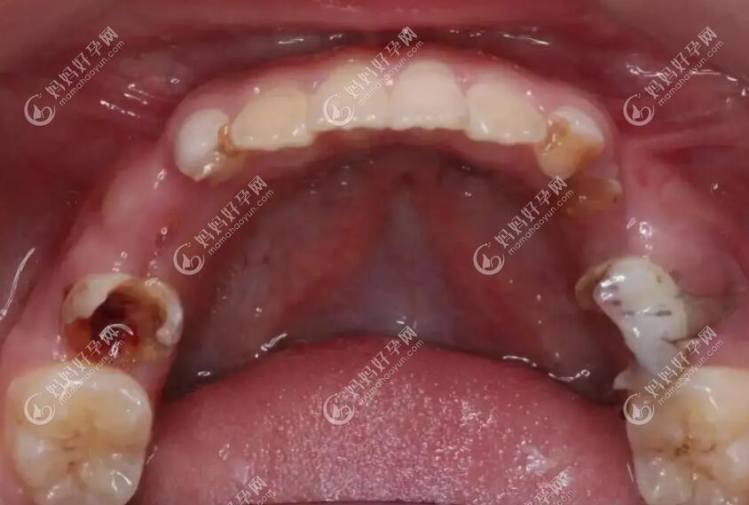 儿童牙齿烂掉就剩牙根怎么