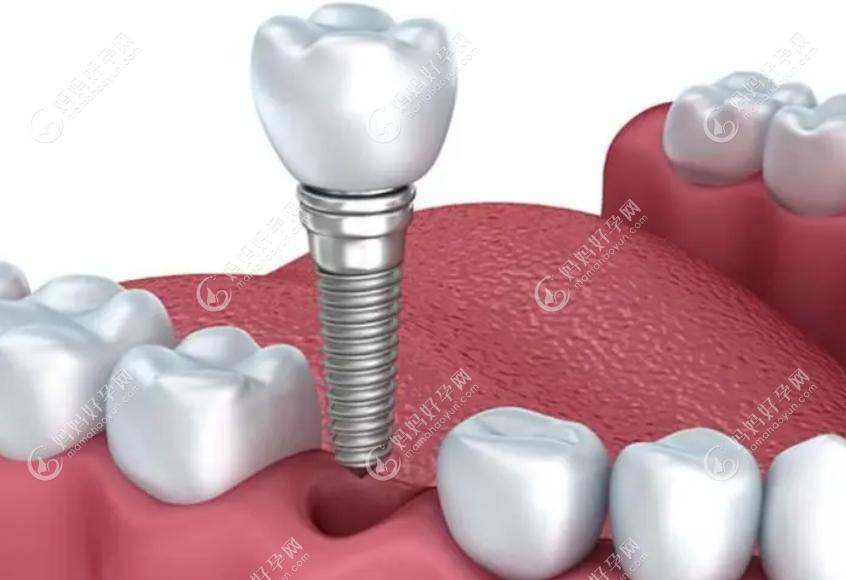 种植牙是目前修复门牙缺失的方法之一