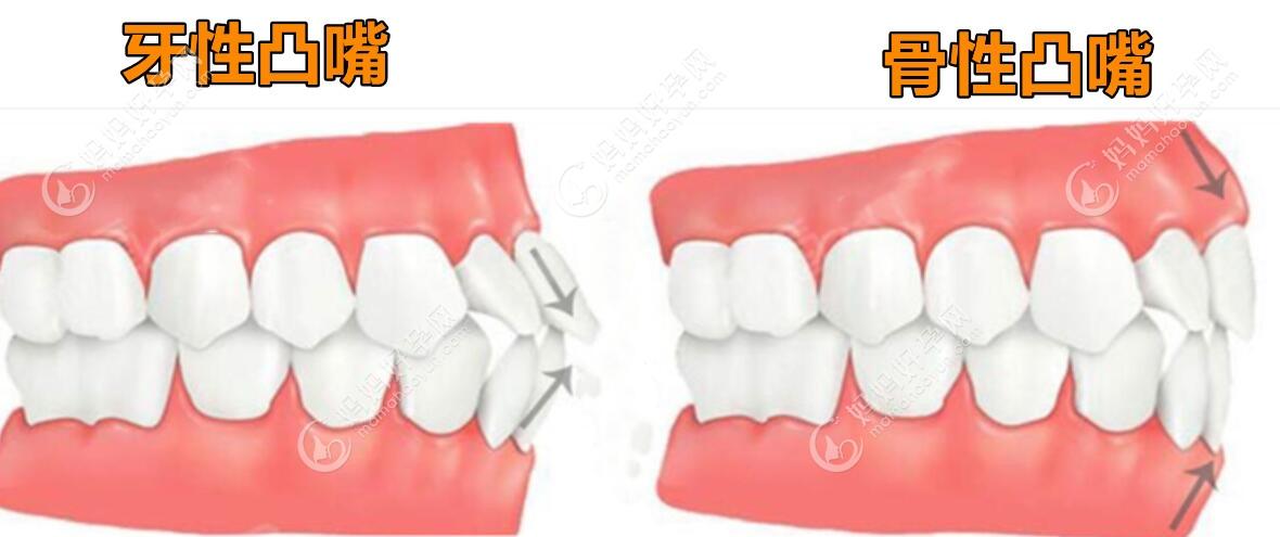 谁有判断骨性凸嘴和牙性凸嘴对比照,骨性嘴突是有什么特征