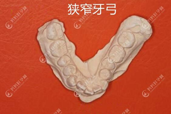 狭窄牙弓的石膏模型