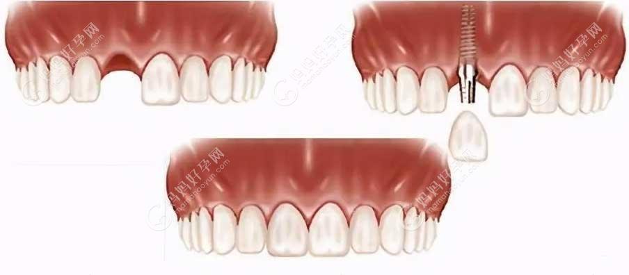 单颗门牙缺失的四个修复方案有隐形义齿/种植牙/全瓷牙等…