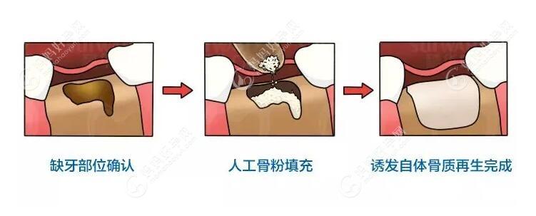 植牙骨粉的全部过程
