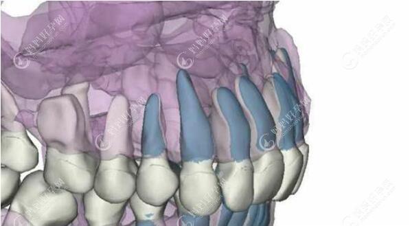 钛金属可和牙槽骨产生骨结合