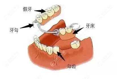 活动假牙一般可以使用多少年