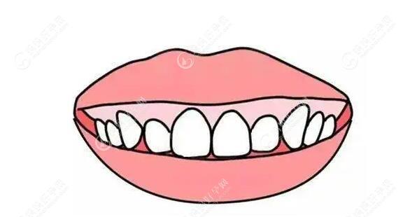 儿童露龈笑在几岁矫正合适？儿牙医生建议佩戴这款矫正器
