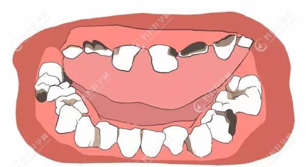 乳牙龋齿蛀牙示意图