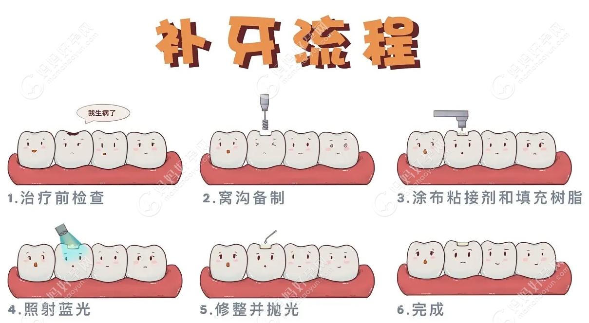 儿童龋齿补牙的流程图