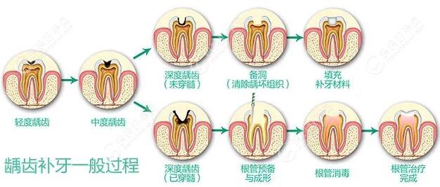 蛀牙补牙流程