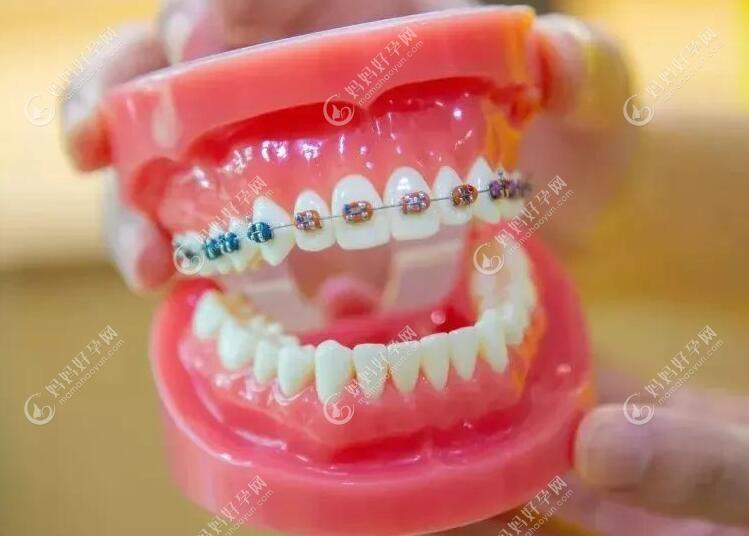 关于半口牙齿矫正的标准
