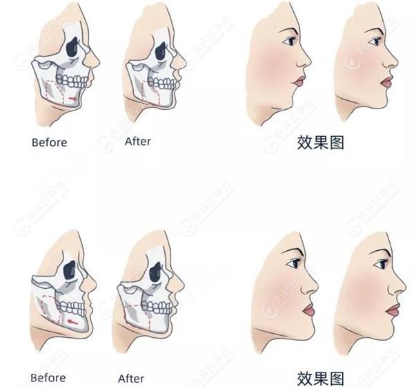 孩子上颌骨突出怎么矫正?正畸不失为一个好的方法