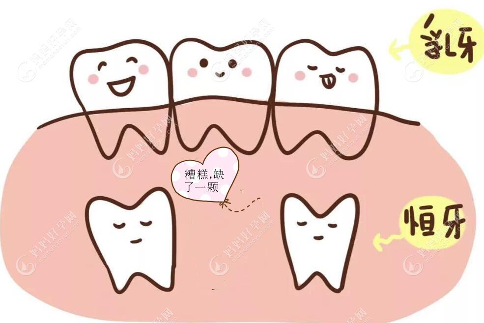 儿童天生少一颗恒牙怎么办这种先天性牙胚缺失该如何治疗