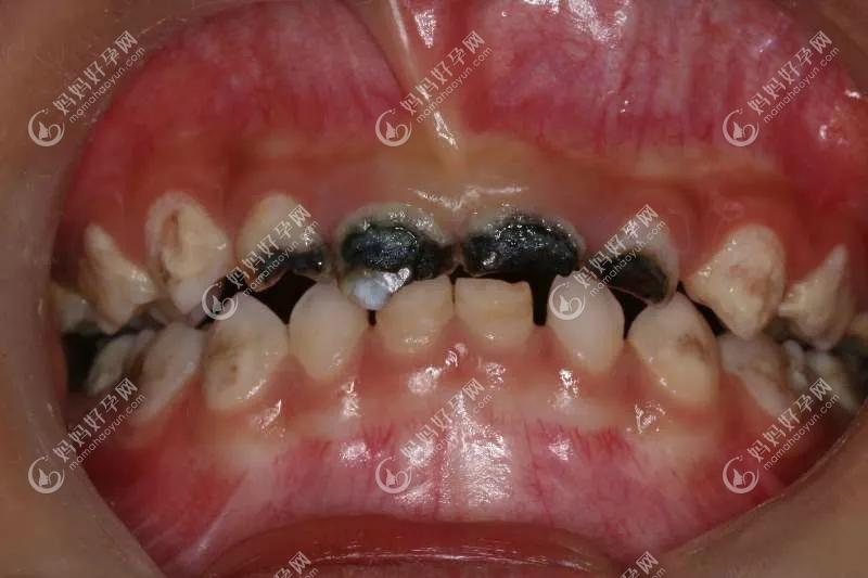 2岁儿童门牙腐烂只剩牙根了,请问小孩牙齿发黑烂掉了怎么治