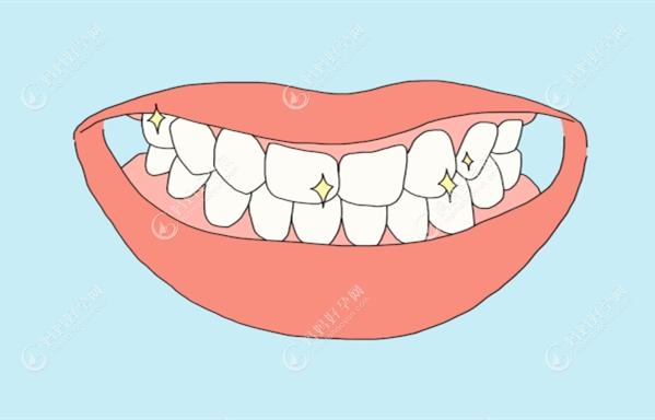 不同牙齿问题对贴面或烤瓷冠的选择不同
