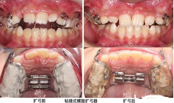 孩子扩弓前后对比照片