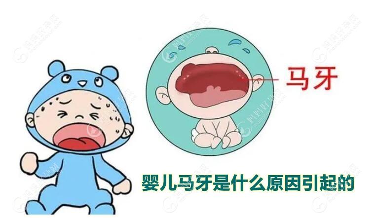 婴儿长马牙是什么原因引起的？马牙和鹅口疮区别是啥？