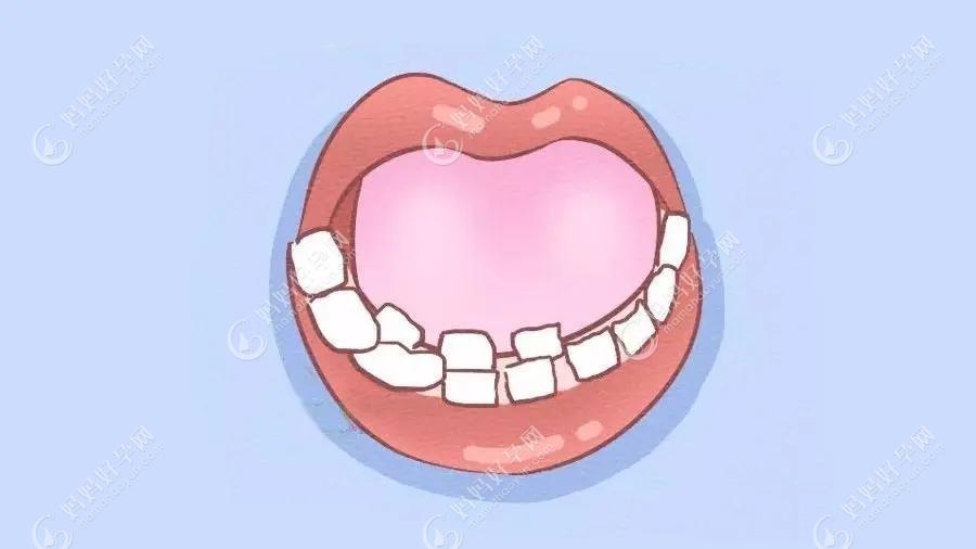 为什么有人乳牙终身不换?话说成人乳牙滞留能用一辈子吗