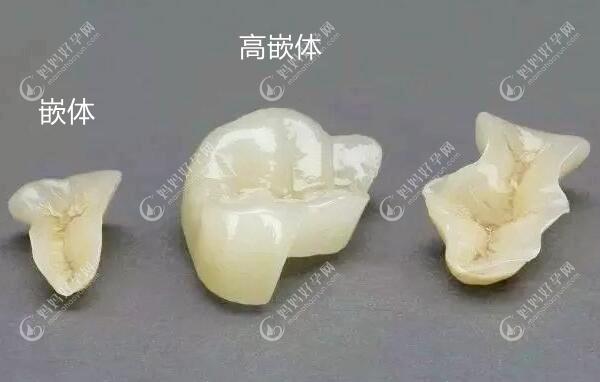 牙齿做嵌体或牙套修复一般多少钱,这嵌体和牙冠哪个贵呢
