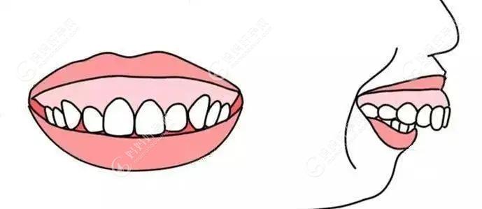 5岁小孩一笑牙龈就外露能矫正吗?露龈笑矫正最佳年龄是几岁