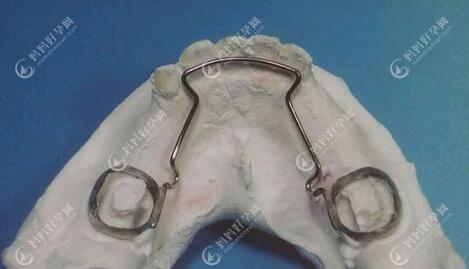固定式儿童牙齿间隙保持器