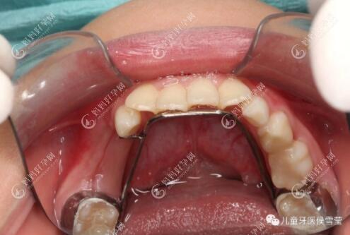 儿童牙齿间隙保持器的作用