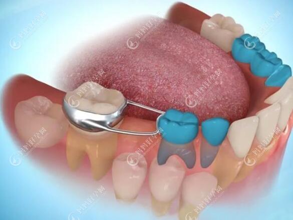 可摘式儿童牙齿间隙保持器