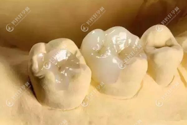 瓷嵌体是在牙模上制作的