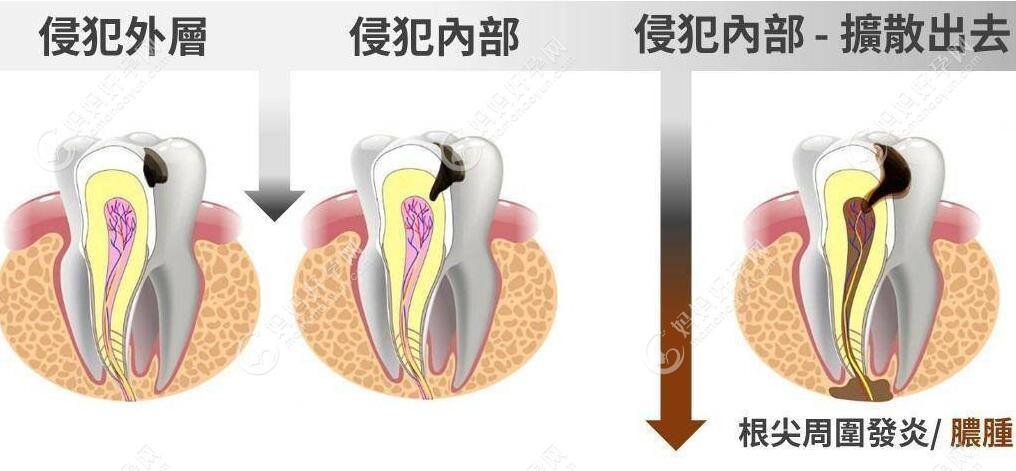儿童乳牙根尖周炎会影响恒牙发育,需及时诊治(附治疗方法)