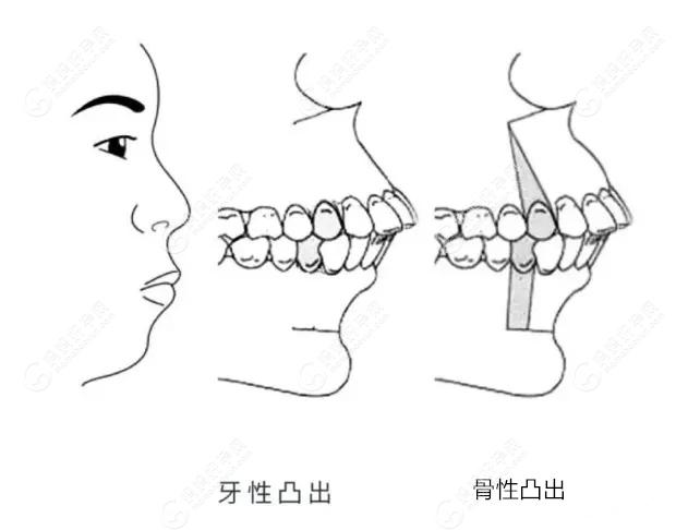 骨性龅牙和牙性龅牙的区别