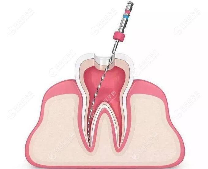 牙根尖病的治疗方法