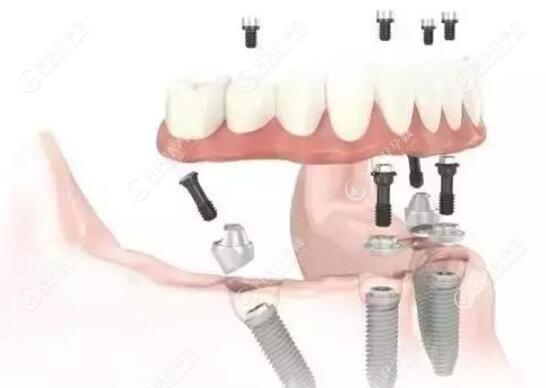 图解allon4种植牙步骤及流程:全半口即刻负重1天时间完成戴牙
