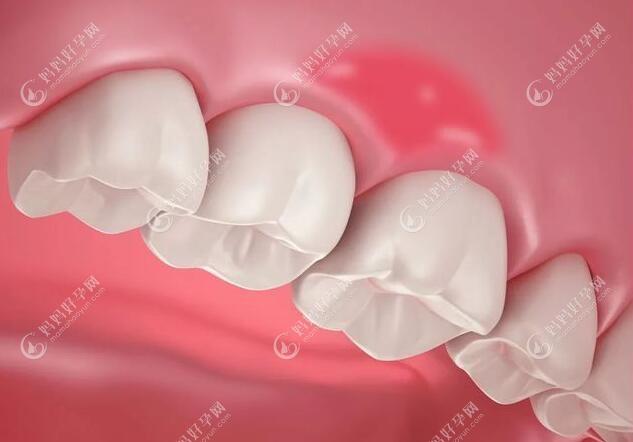 儿童牙龈长脓包是怎么回事