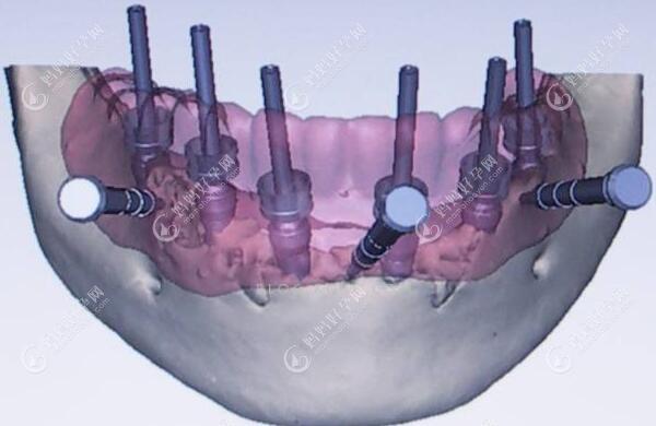 导板种植手术位置模拟