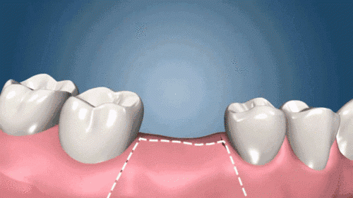 种植牙二期手术